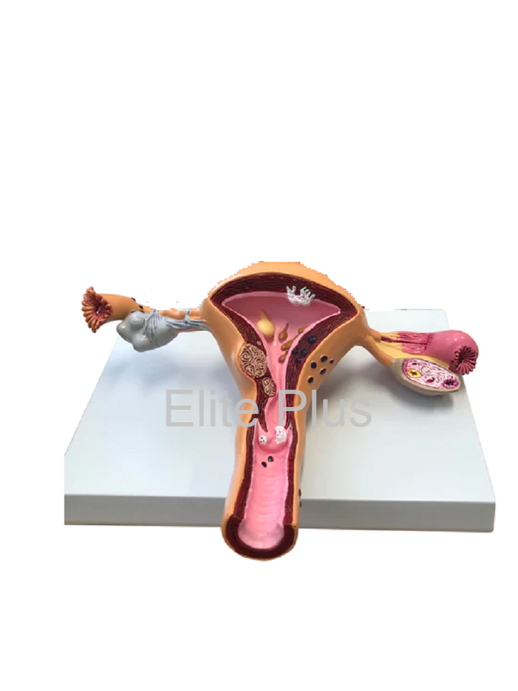 Uerus & Ovary Pathalogies Model