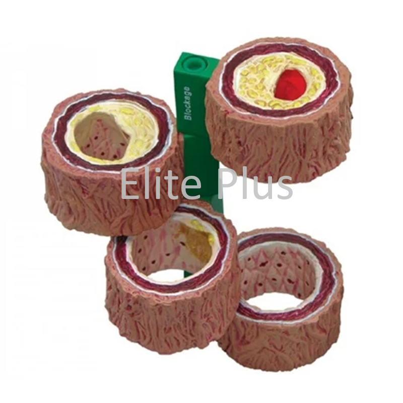 ZX-1517P 4 Stage Blocked Artery (Atherosclerosis) Model