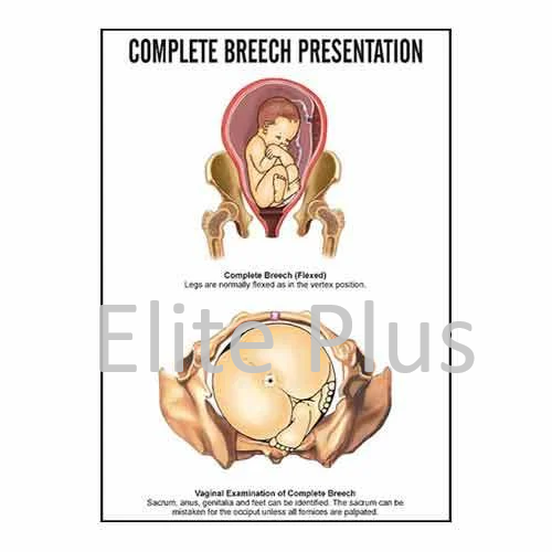 Complete Breech Presentation