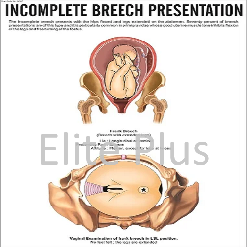 Incomplete Breech Presentation
