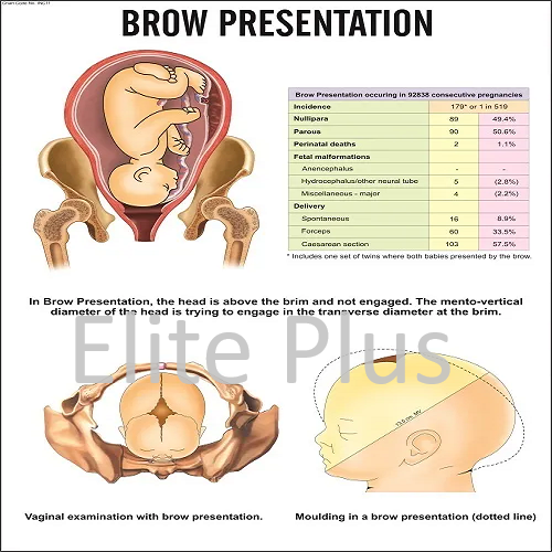 Brow Presentation