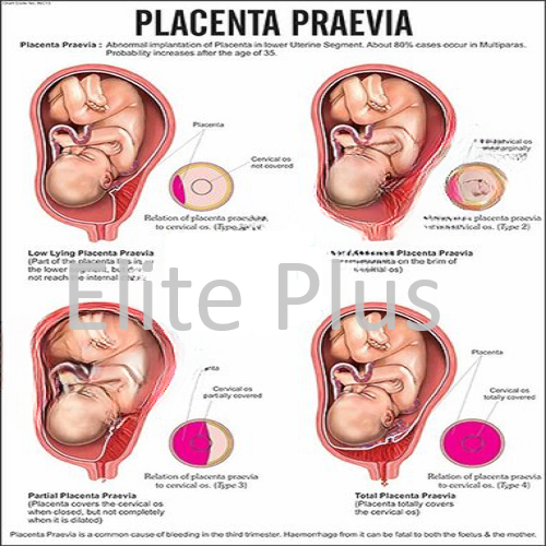 Placenta Praevia