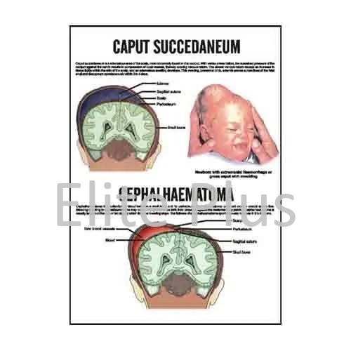 Caput Succedaneum, Cephalhaematoma