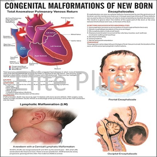 Congenital Malformation of New Born