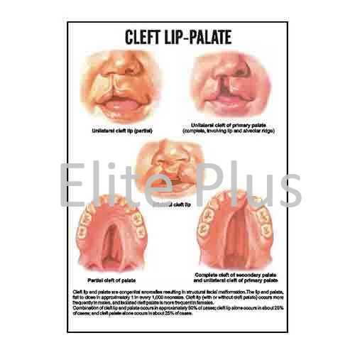 Cleft lip-Palate
