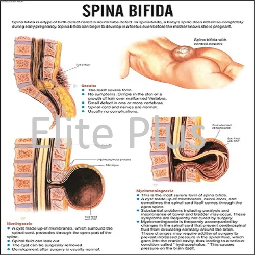 Spina Bifida