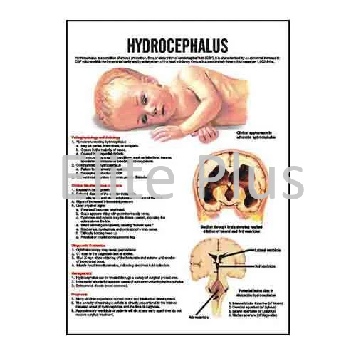 Hydrocephalus