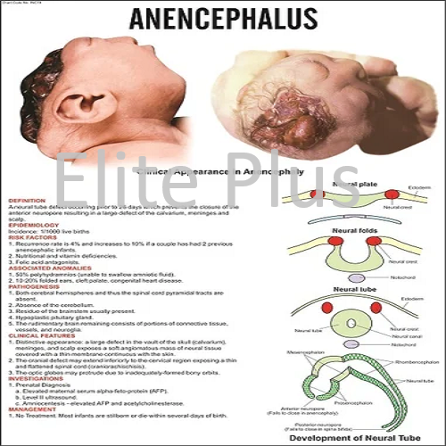 Anencephalus