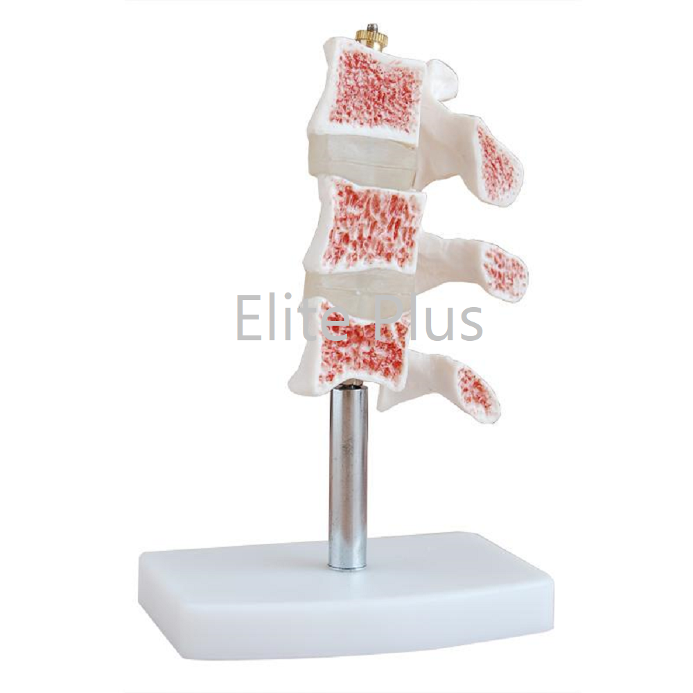 XC-134 Cutaway Osteoporosis